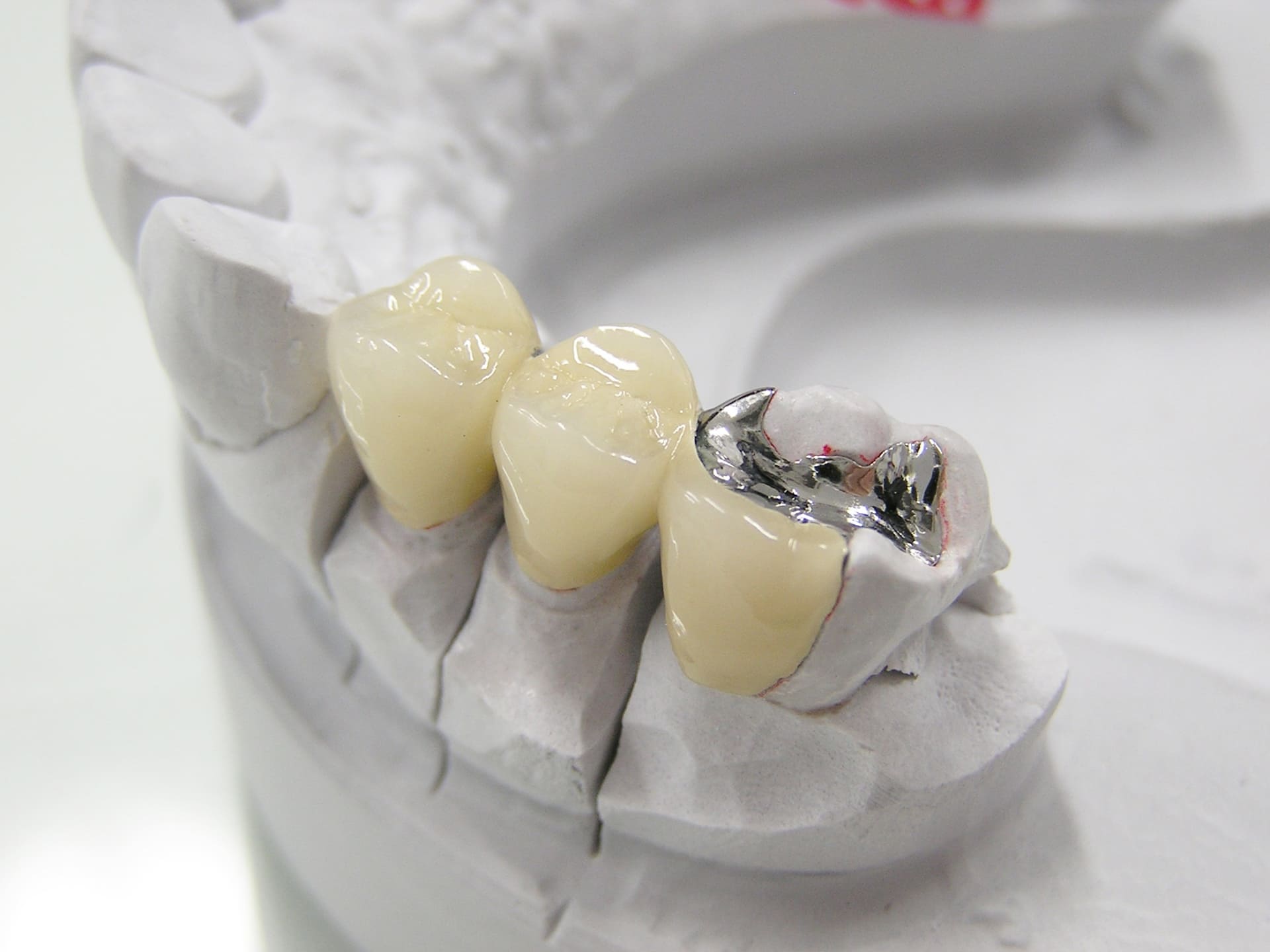 詰め物・被せ物